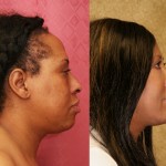 Eyelid (Blepharoplasty) Before & After Patient #6592