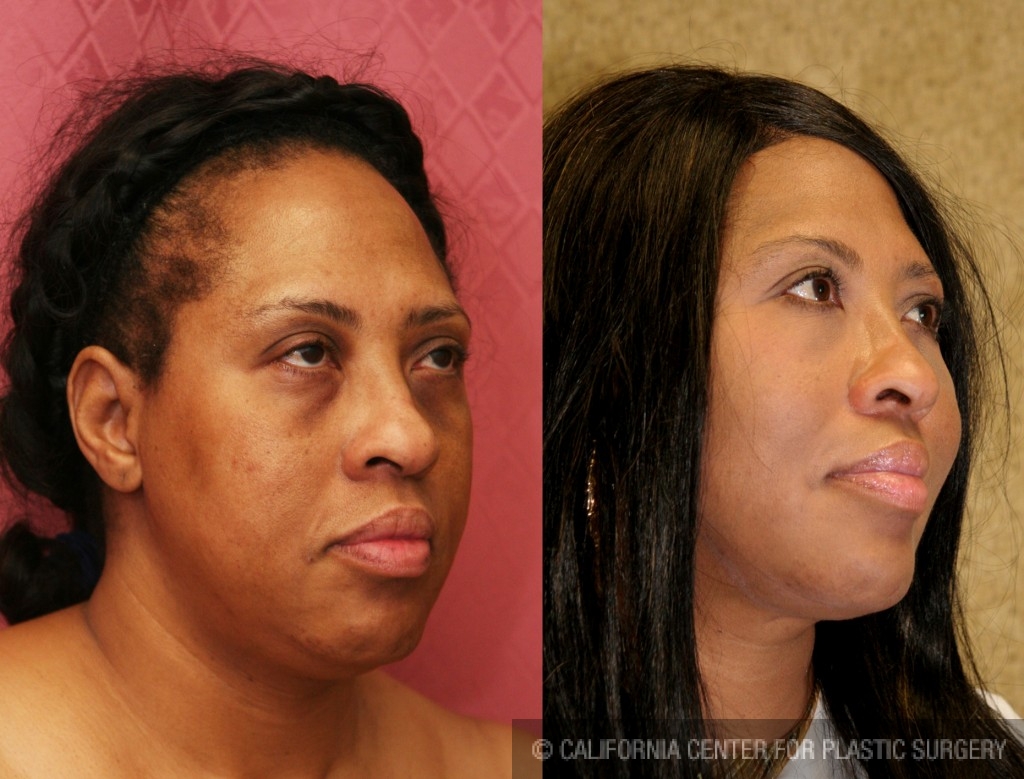 Eyelid (Blepharoplasty) Before & After Patient #6592