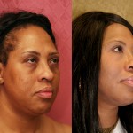 Eyelid (Blepharoplasty) Before & After Patient #6592