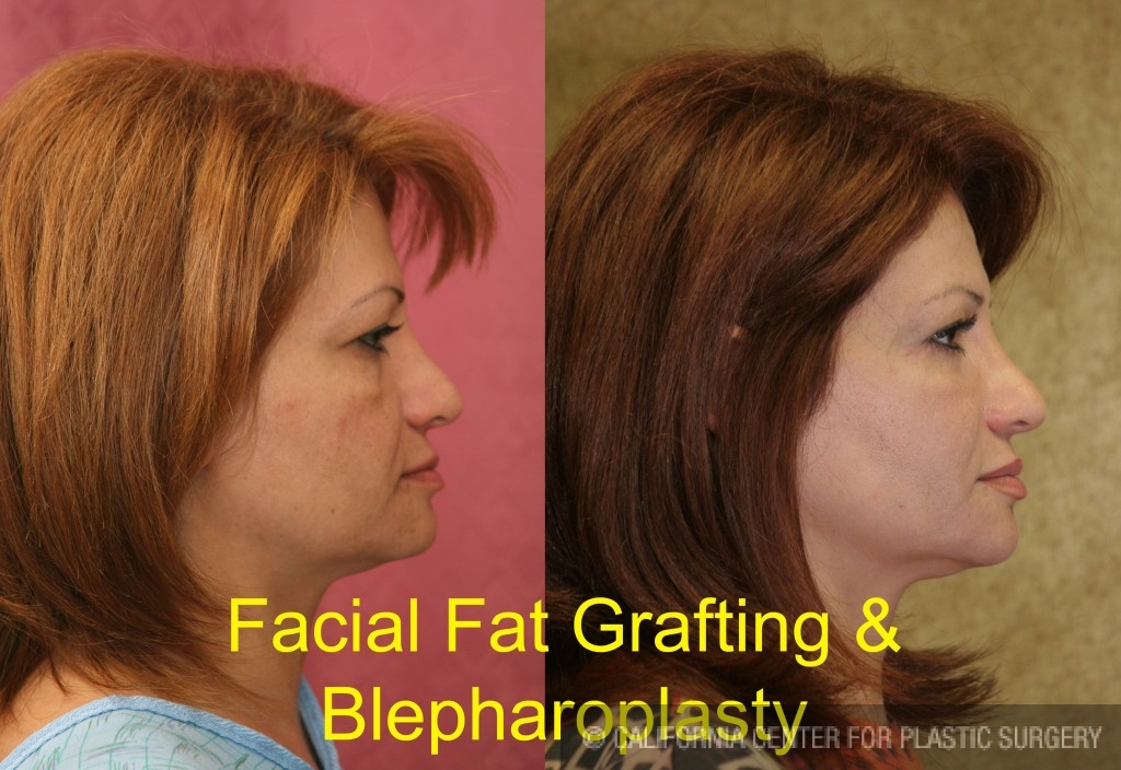 Facial Fat Grafting Before & After Patient #6757