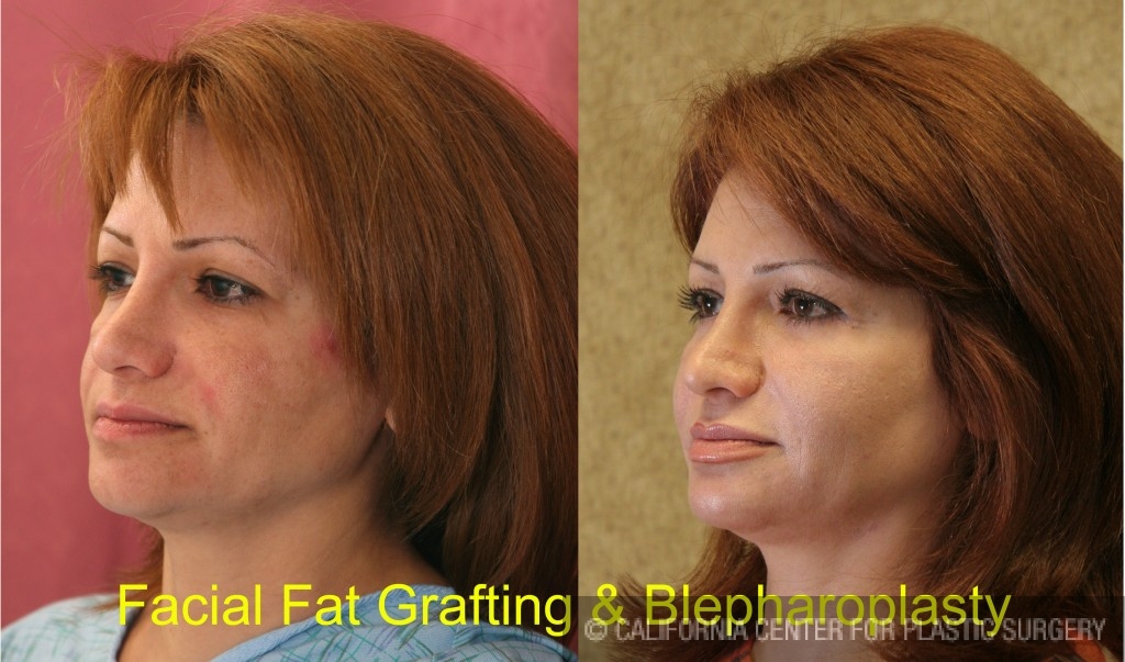 Facial Fat Grafting Before & After Patient #6757