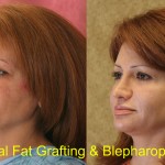 Facial Fat Grafting Before & After Patient #6757