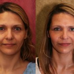 Eyelid (Blepharoplasty) Before & After Patient #6486