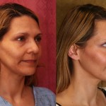 Eyelid (Blepharoplasty) Before & After Patient #6486