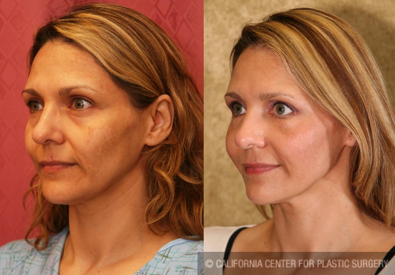 Eyelid (Blepharoplasty) Before & After Patient #6486