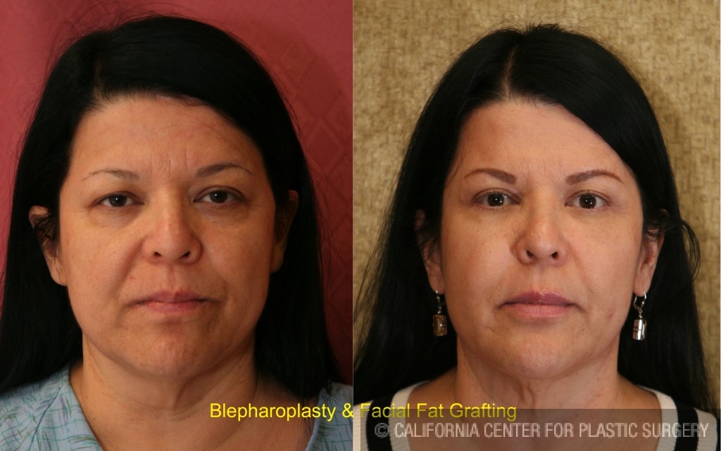 Eyelid (Blepharoplasty) Before & After Patient #6583