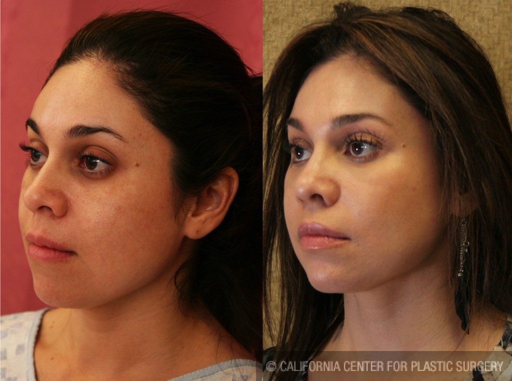 Eyelid (Blepharoplasty) Before & After Patient #6570