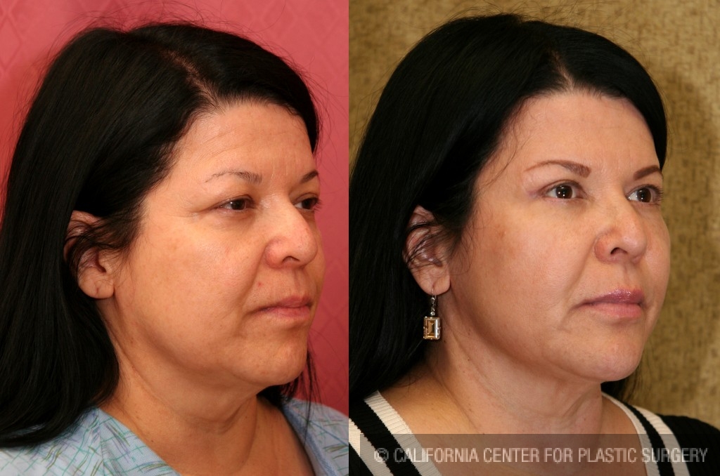 Eyelid (Blepharoplasty) Before & After Patient #6583