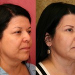 Eyelid (Blepharoplasty) Before & After Patient #6583
