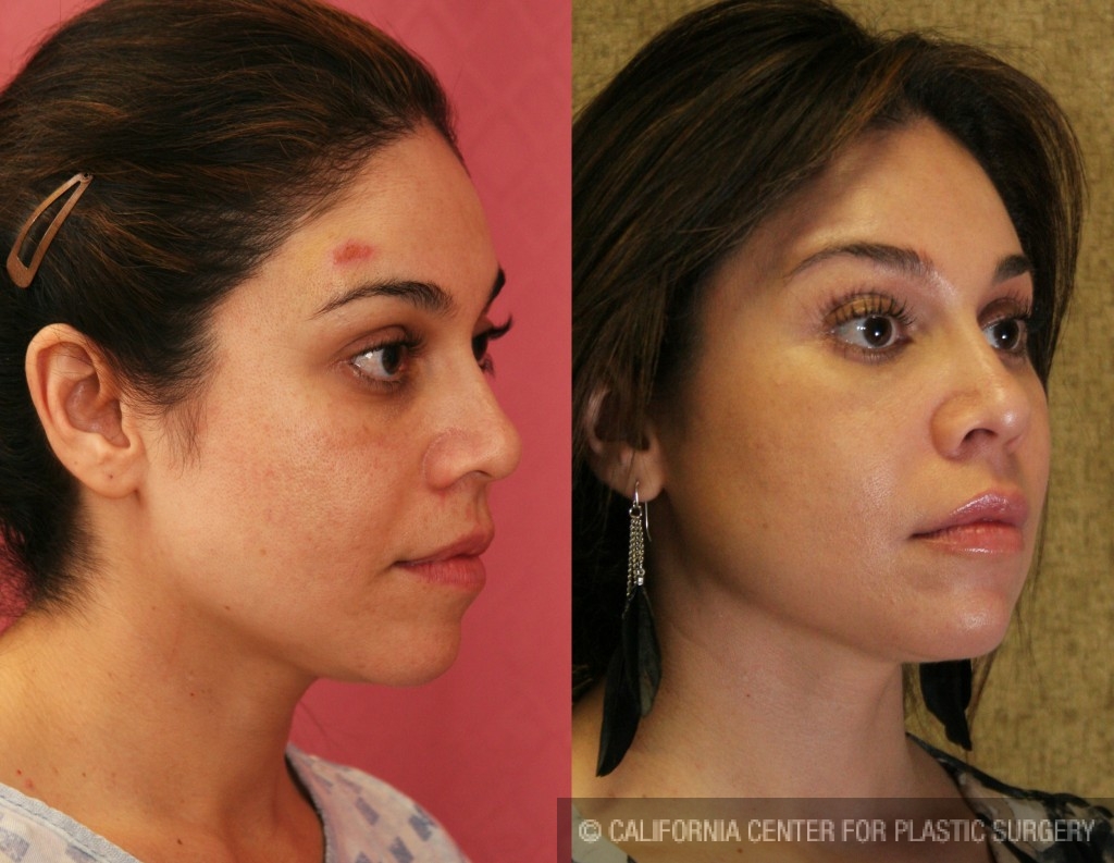 Eyelid (Blepharoplasty) Before & After Patient #6570