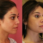 Facial Fat Grafting Before & After Patient #6734