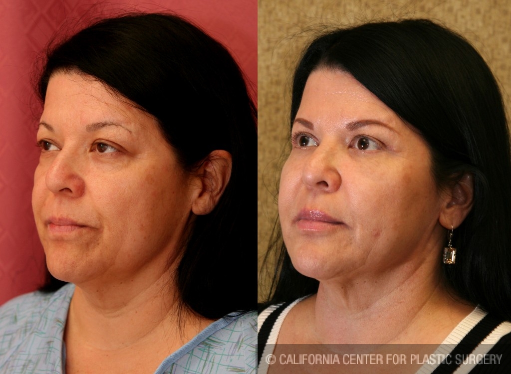 Eyelid (Blepharoplasty) Before & After Patient #6583