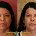 Facial Fat Grafting Before & After Patient #6767