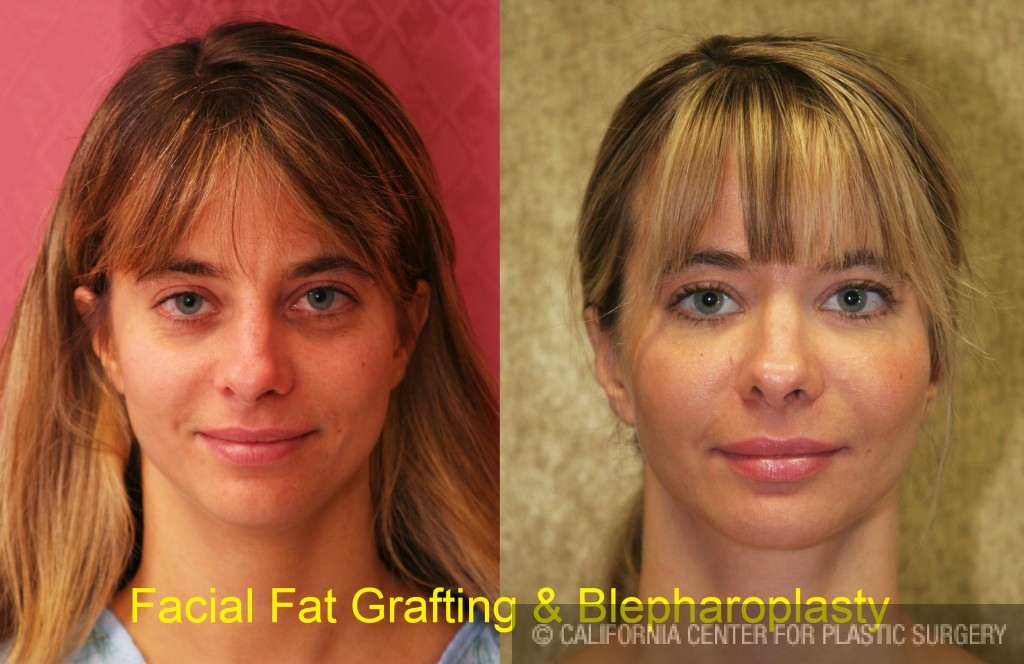 Facial Fat Grafting Before & After Patient #6600