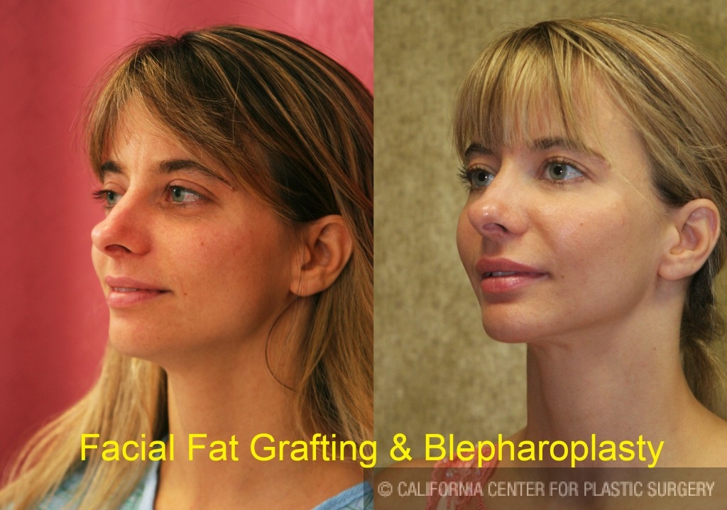 Facial Fat Grafting Before & After Patient #6600