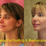 Facial Fat Grafting Before & After Patient #6600