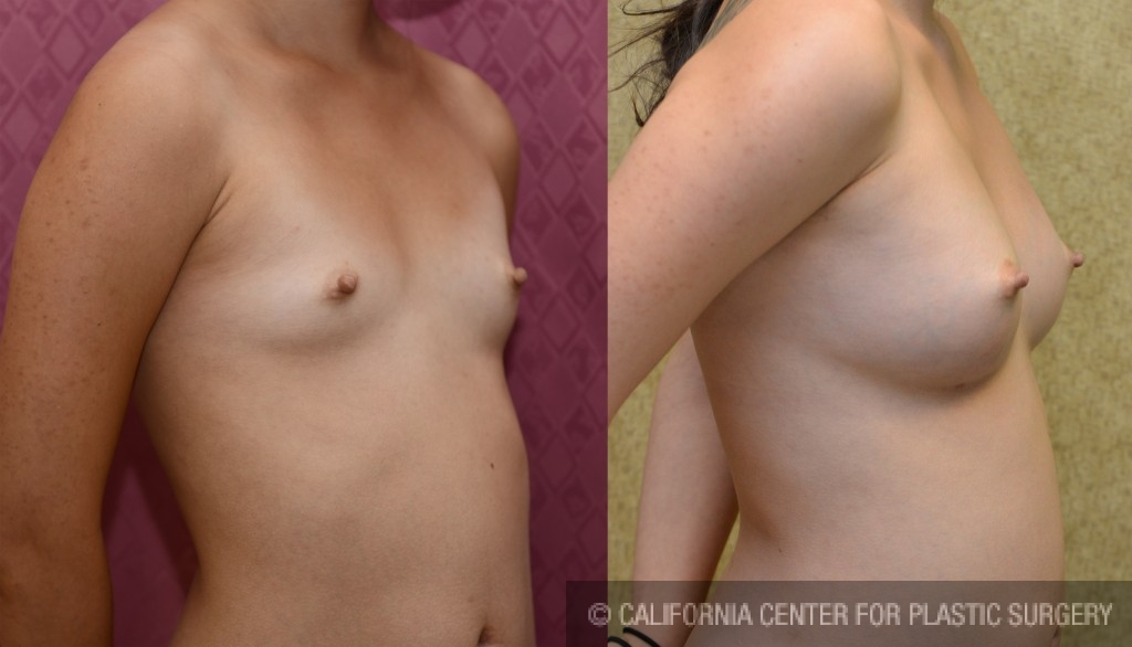 Breast Augmentation Before & After Patient #5281