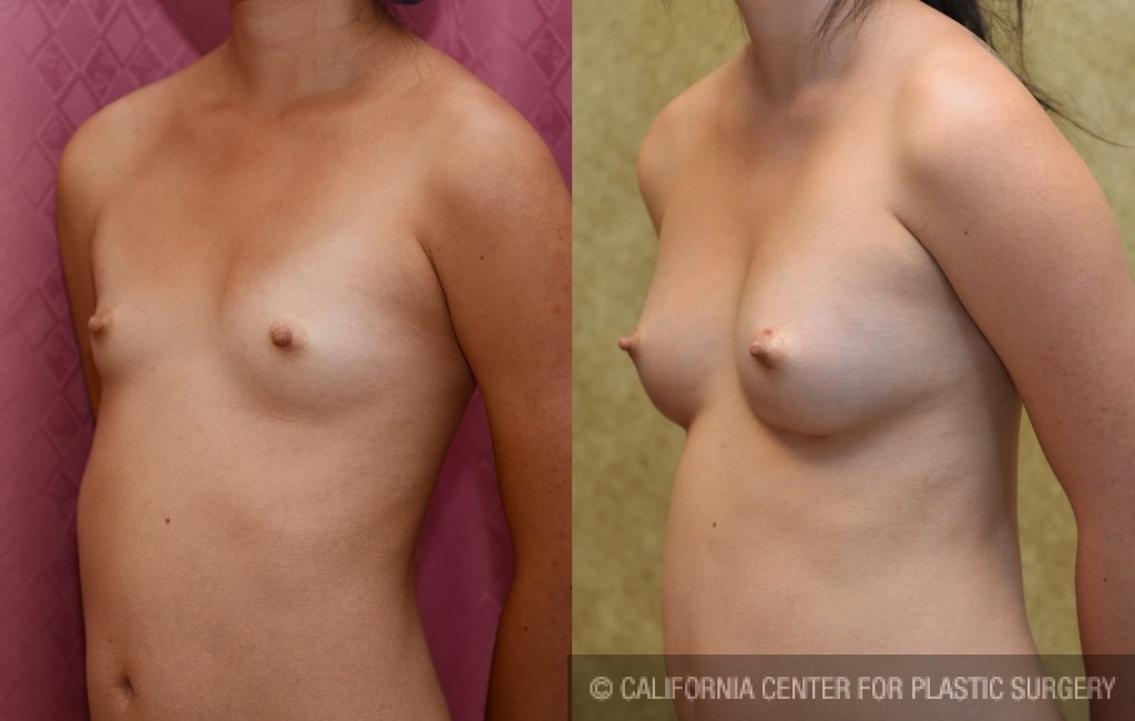 Breast Augmentation Before & After Patient #5281