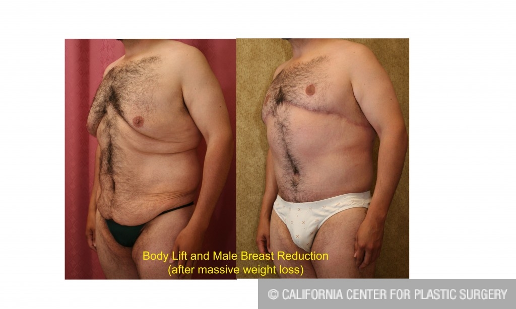 After Weight Loss Before and After Photo Gallery, Los Angeles, CA