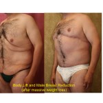 Male gynecomastia (breast) reduction Before & After Patient #6839