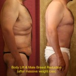 Male Tummy Tuck (abdominoplasty) Before & After Patient #6023