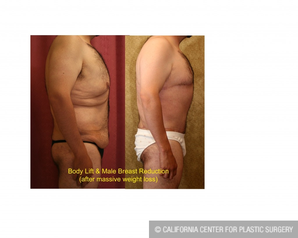 Male gynecomastia (breast) reduction Before & After Patient #6839