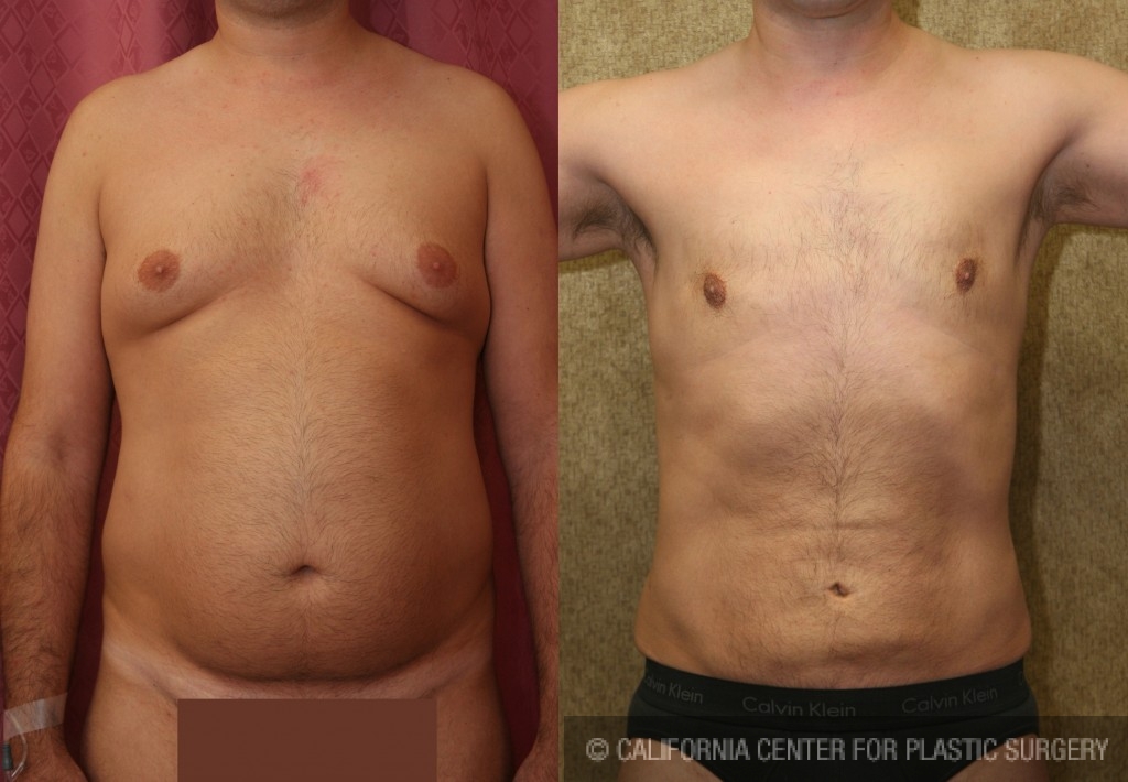 Patient #5642 Male Liposuction Abdomen Before and After Photos Beverly  Hills - Plastic Surgery Gallery Los Angeles, CA - Dr. Sean Younai