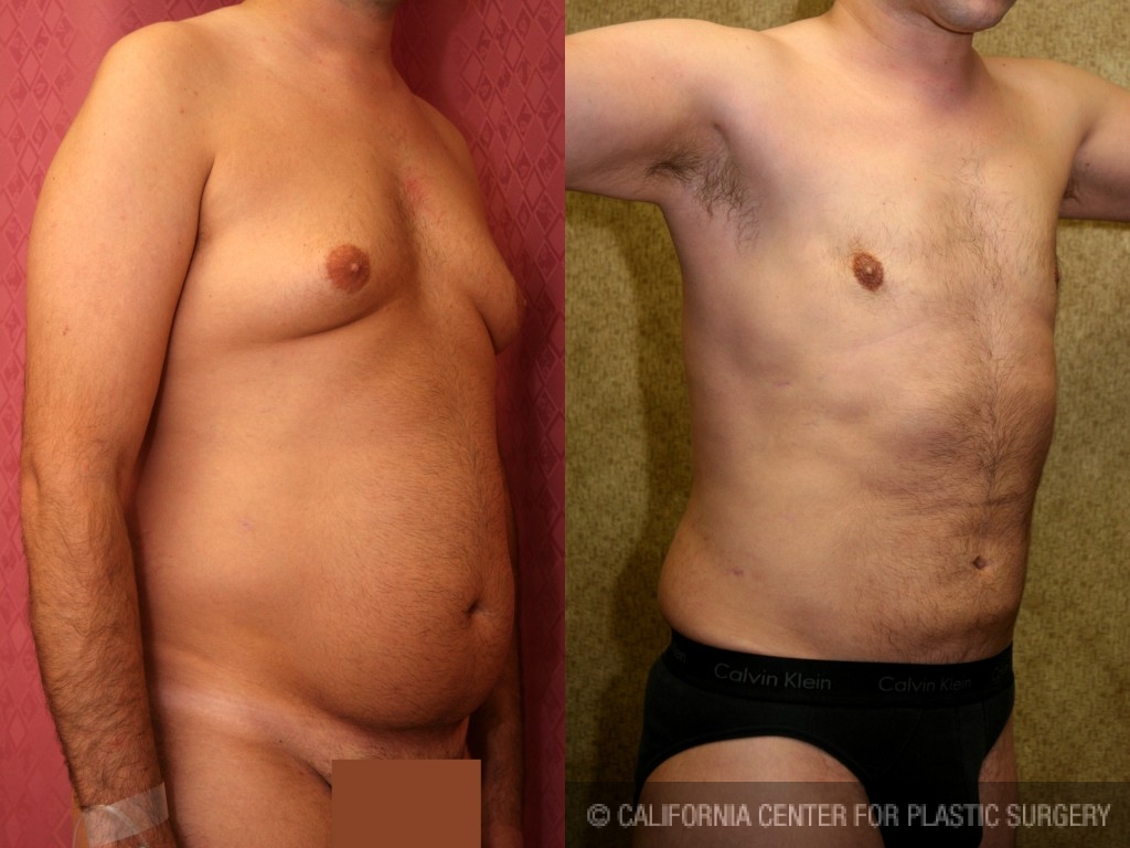 Male Liposuction Abdomen Before & After Patient #5642