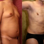 Male Liposuction Abdomen Before & After Patient #5642