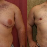 Male gynecomastia (breast) reduction Before & After Patient #6814