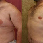 Male gynecomastia (breast) reduction Before & After Patient #6814