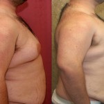 Male gynecomastia (breast) reduction Before & After Patient #6814