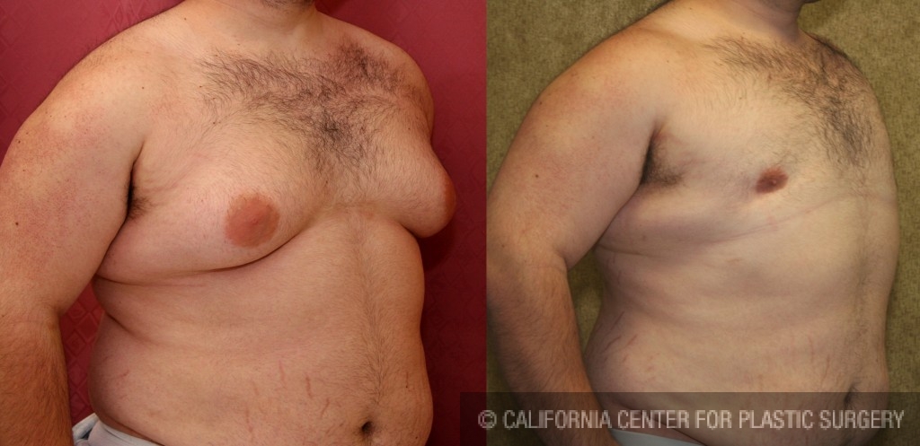 Male gynecomastia (breast) reduction Before & After Patient #6814