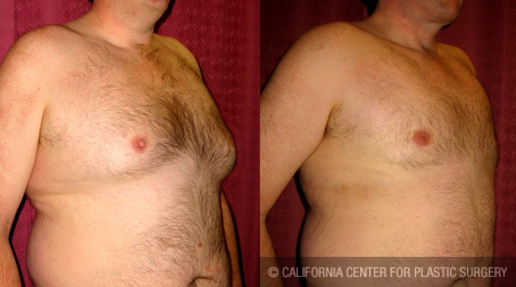 Male gynecomastia (breast) reduction Before & After Patient #6827