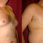 Male gynecomastia (breast) reduction Before & After Patient #6827