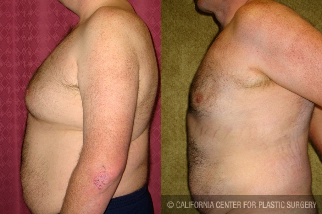 Male gynecomastia (breast) reduction Before & After Patient #6827