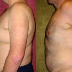 Male gynecomastia (breast) reduction Before & After Patient #6827