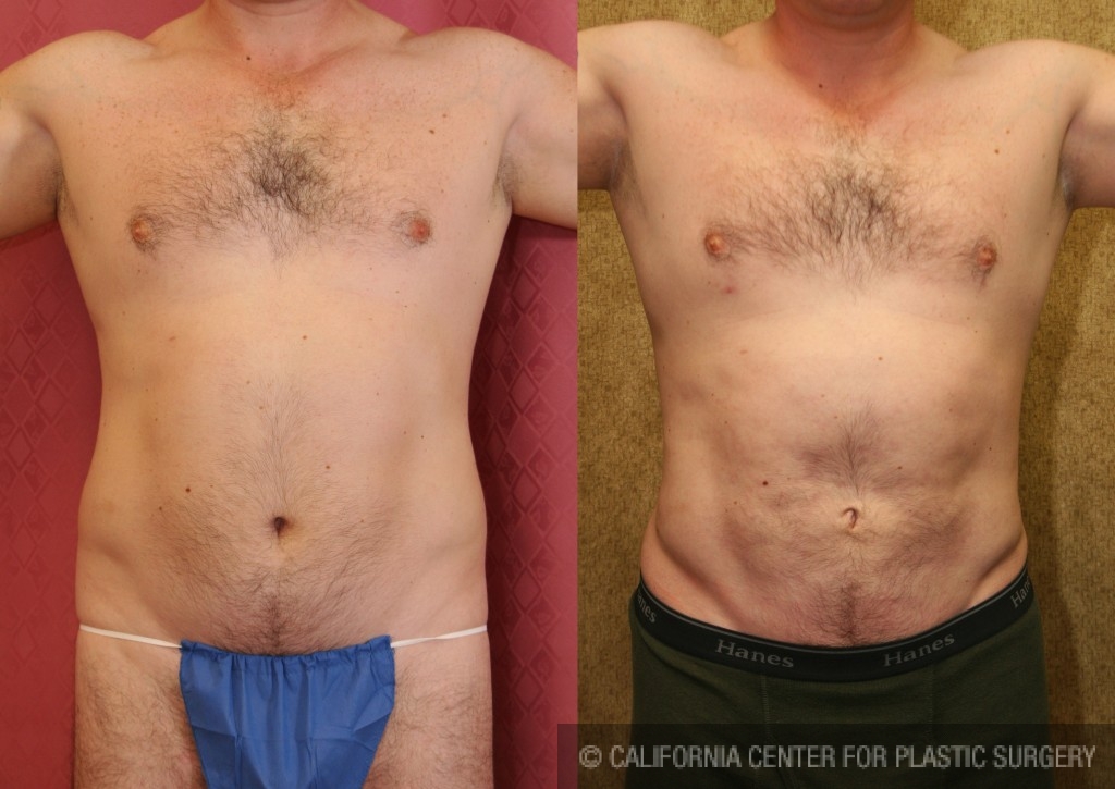 Male Liposuction Abdomen Before & After Patient #5665