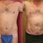 Male Liposuction Abdomen Before & After Patient #5665