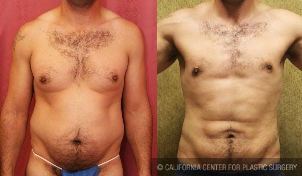 Male Liposuction Abdomen Before & After Patient #5680