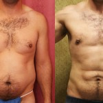 Male Liposuction Abdomen Before & After Patient #5680
