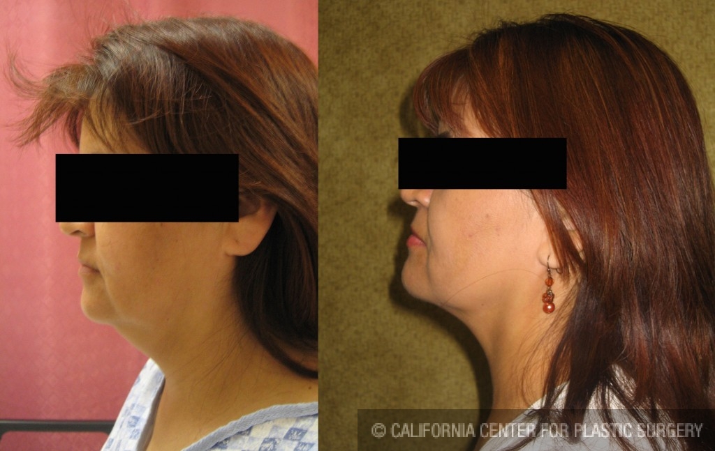 Neck & Face Liposuction Before & After Patient #6640