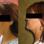 Neck & Face Liposuction Before & After Patient #6640