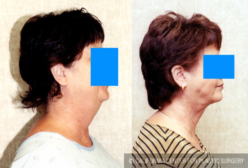 Neck & Face Liposuction Before & After Patient #6647