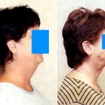 Neck & Face Liposuction Before & After Patient #6647