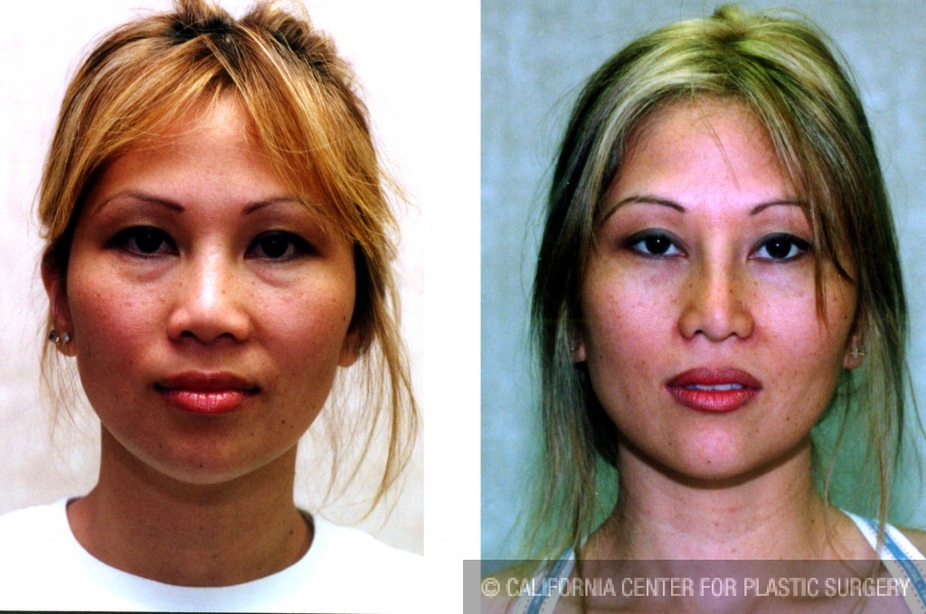 Patient 6379 Asian Rhinoplasty Before and After Photos