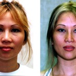 Rhinoplasty - Asian Before & After Patient #6379