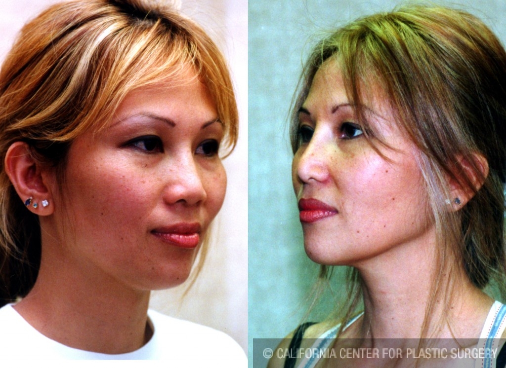 Rhinoplasty - Asian Before & After Patient #6379