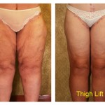 Thigh Lift Before & After Patient #4198