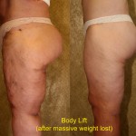Thigh Lift Before & After Patient #4198